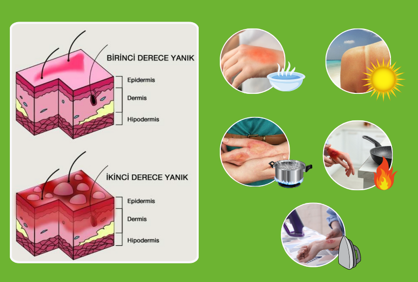 1. ve 2. Derece Yanıkların Doğru Tedavisi ve Hızlı İyileşme 